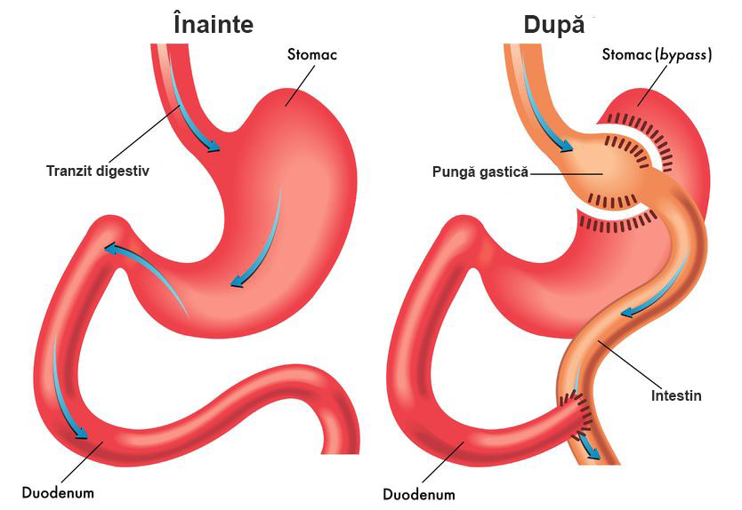 grafica bypass gastric