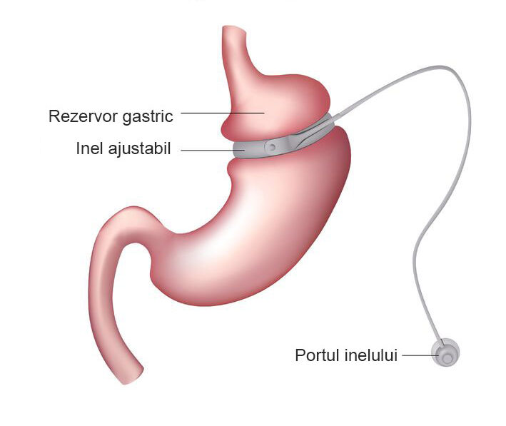 grafic inel gastric