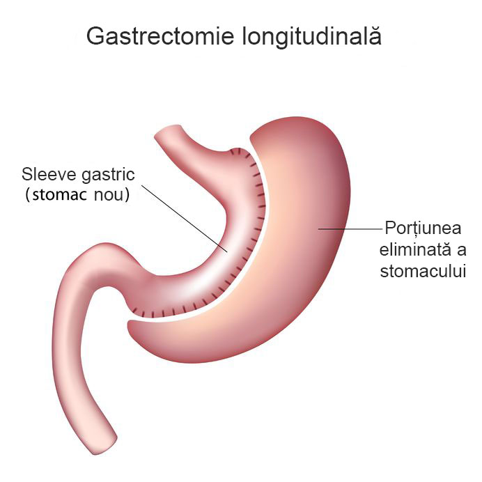 illustratie micsorarea stomacului gastric sleeve 
